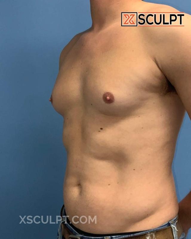 Gynecomastia Surgery before at XSculpt in Chicago, IL