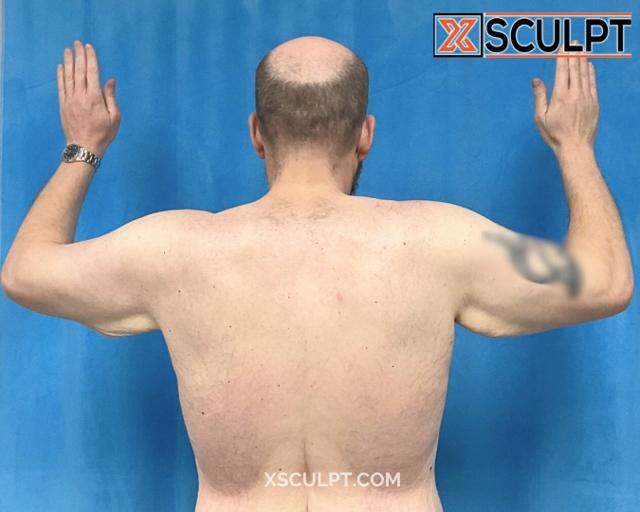 Arm Lift before at XSculpt in Chicago, IL