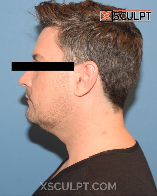 Neck Liposuction before at XSculpt in Chicago, IL
