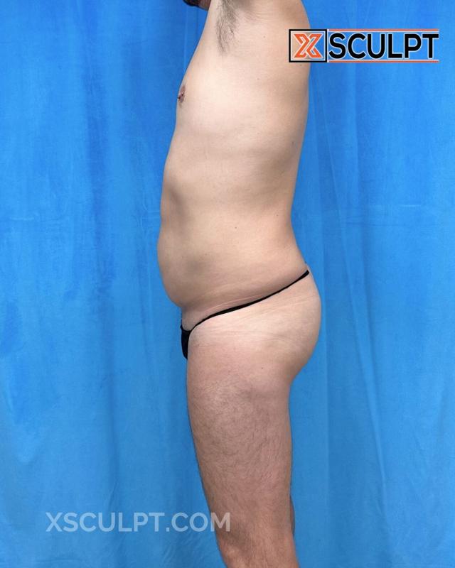 Brazilian Butt Lift after at XSculpt in Chicago, IL