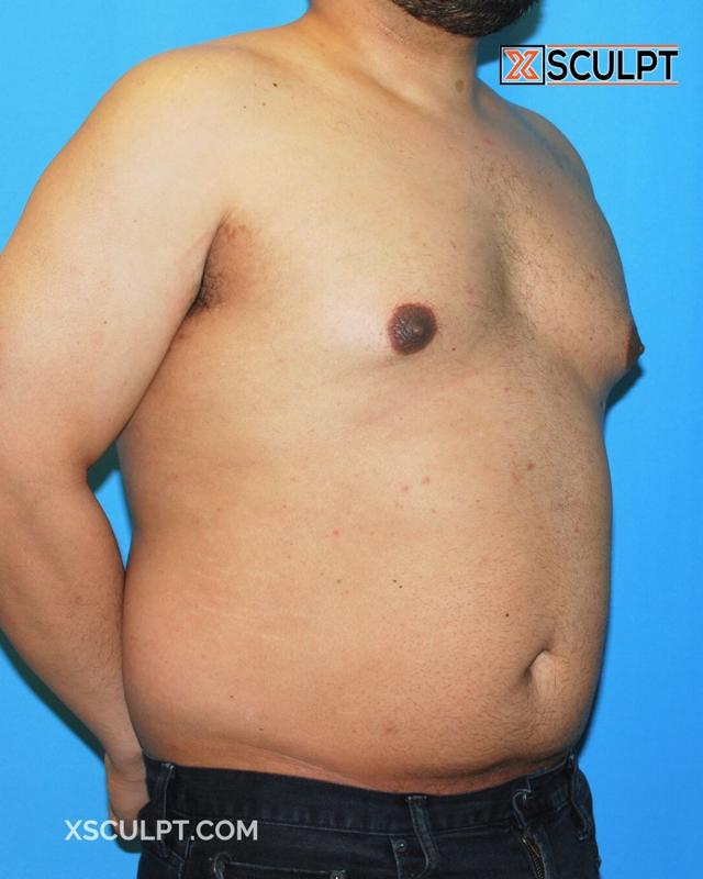 Gynecomastia Surgery before at XSculpt in Chicago, IL