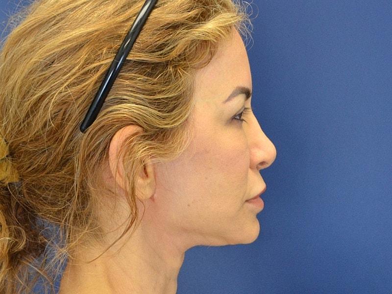 Heights Plastic Surgery facelift after — Houston, TX