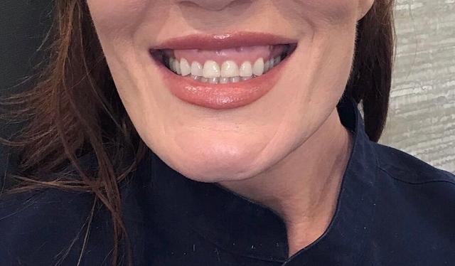 Botox before at Heights Plastic Surgery in Houston, TX