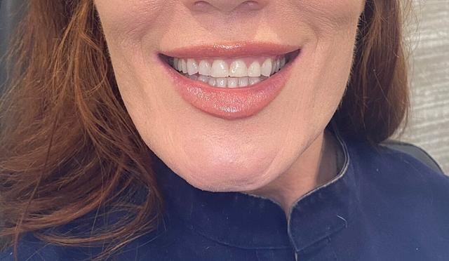 Botox after at Heights Plastic Surgery in Houston, TX