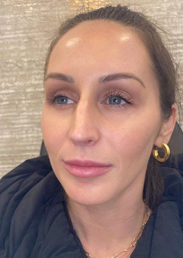 Dermal Fillers after at Heights Plastic Surgery in Houston, TX