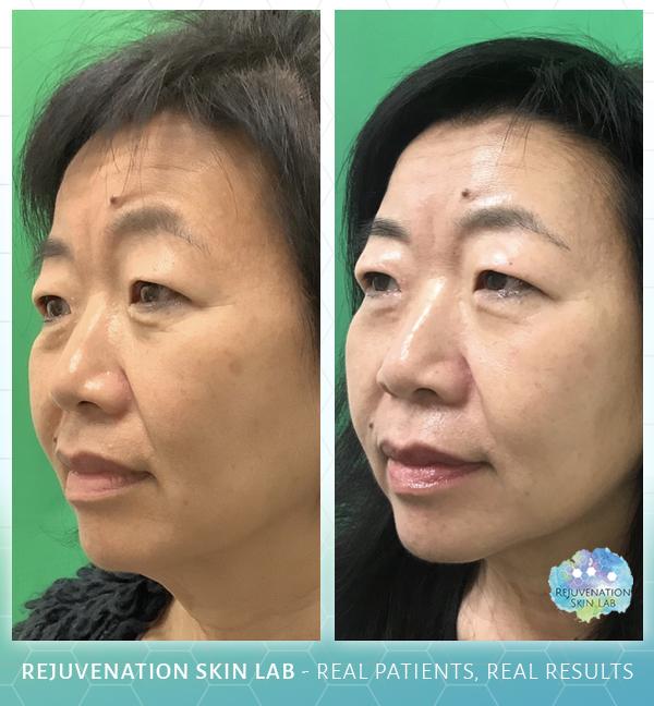 Rejuvenation Skin Lab result — Richmond, VA