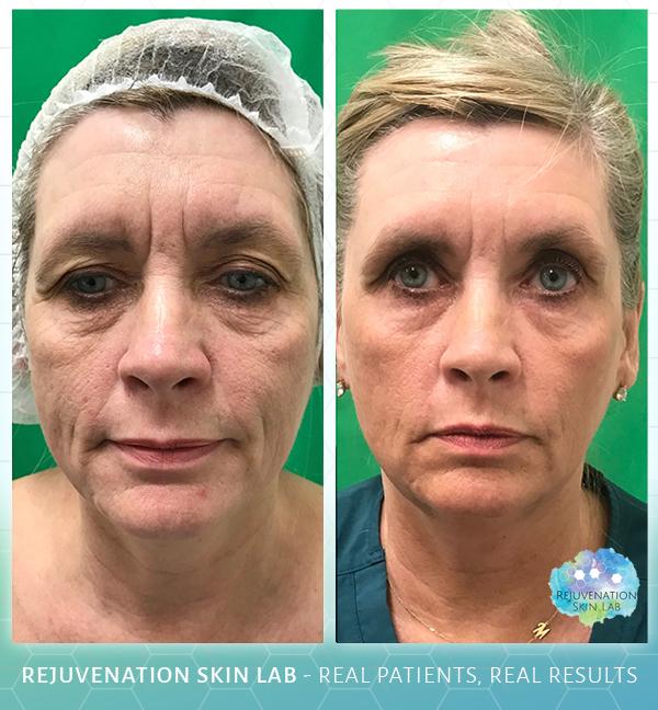 Rejuvenation Skin Lab result — Richmond, VA