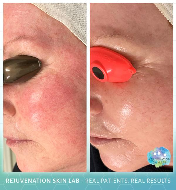 Rejuvenation Skin Lab result — Richmond, VA