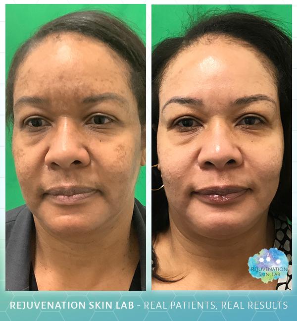 Rejuvenation Skin Lab result — Richmond, VA