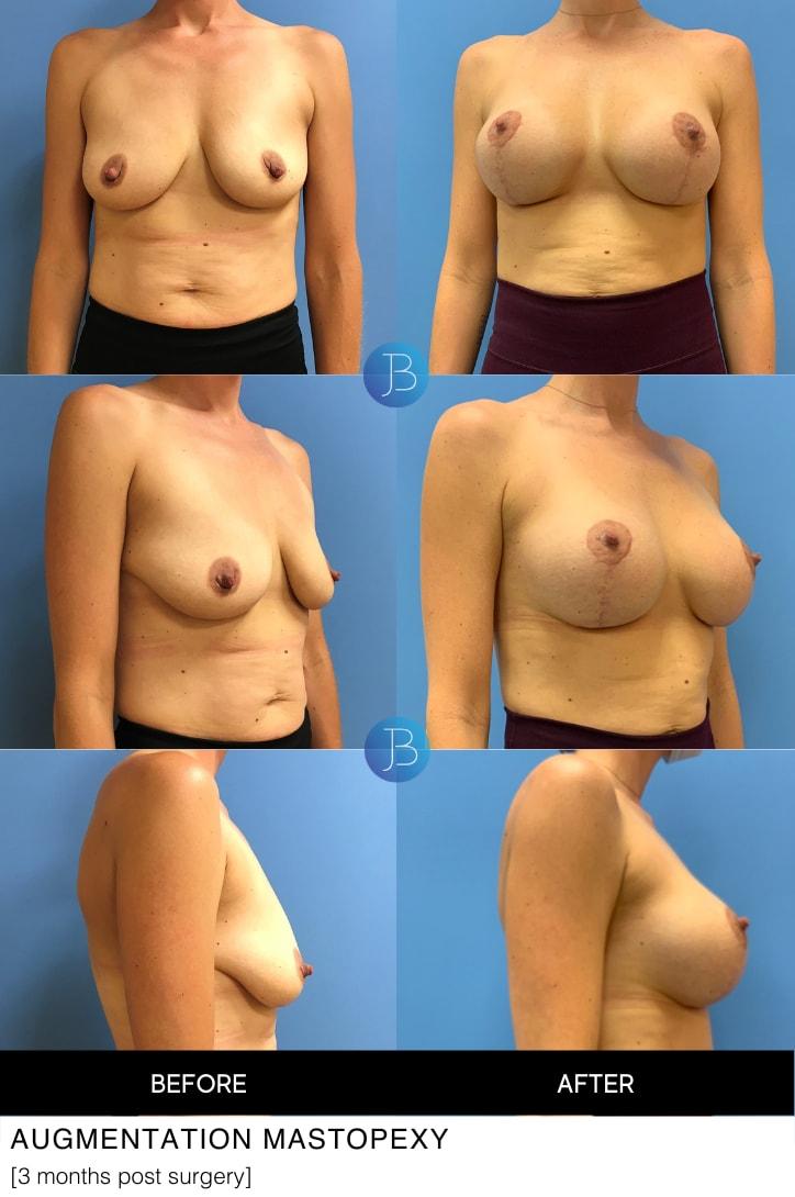 Bloom Plastic Surgery breast lift result — Chicago, IL