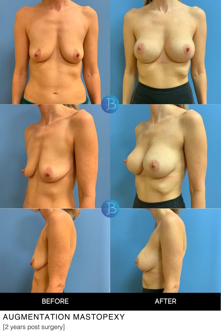 Bloom Plastic Surgery breast lift result — Chicago, IL