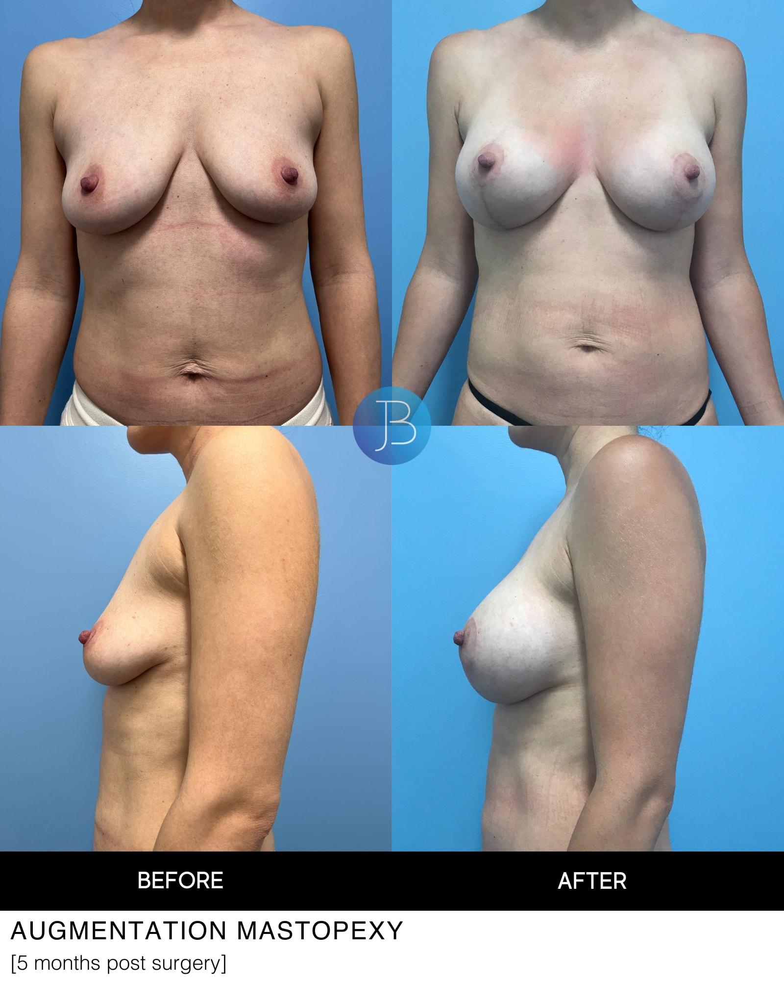 Bloom Plastic Surgery breast lift result — Chicago, IL