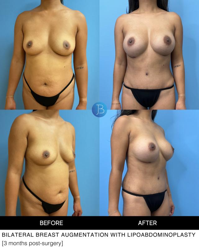 Mommy Makeover result at Bloom Plastic Surgery in Chicago, IL