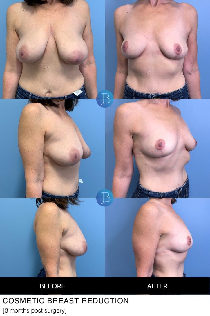 Bloom Plastic Surgery breast reduction result — Chicago, IL