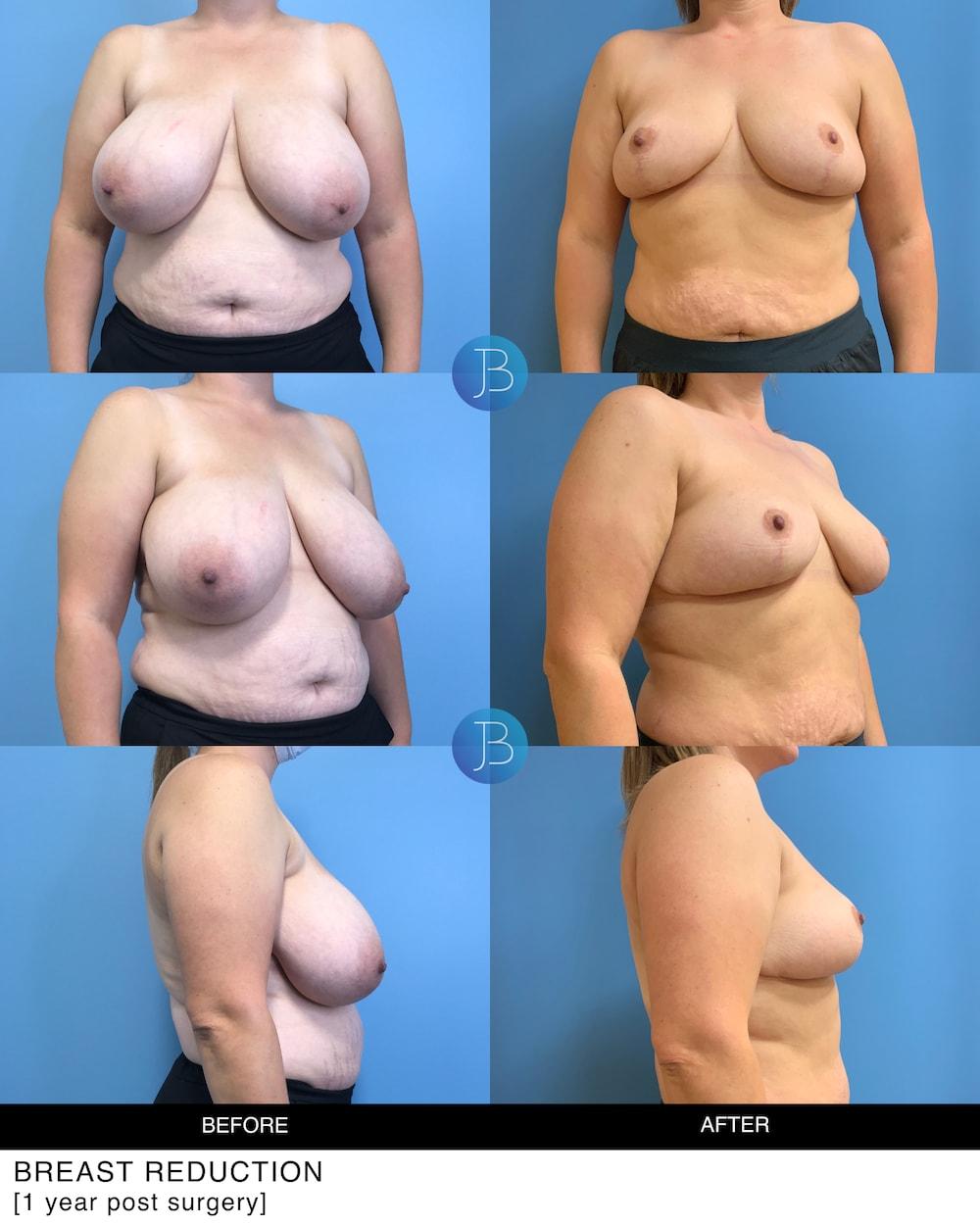 Bloom Plastic Surgery breast reduction result — Chicago, IL