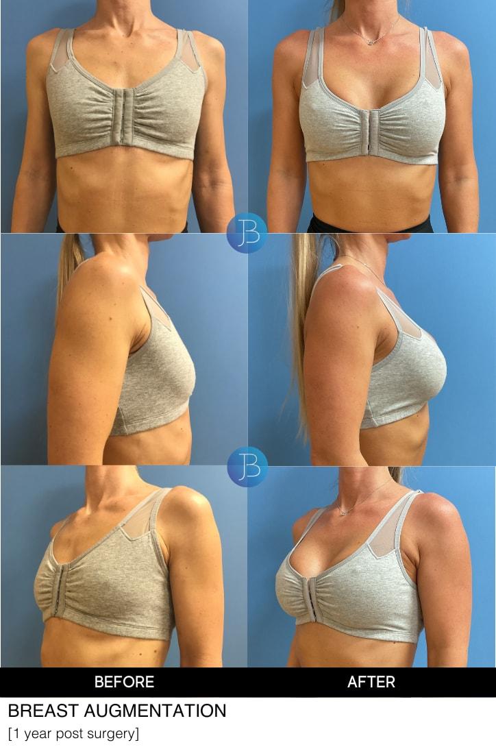 Bloom Plastic Surgery breast augmentation result — Chicago, IL
