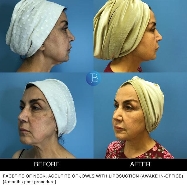 Neck Liposuction result at Bloom Plastic Surgery in Chicago, IL