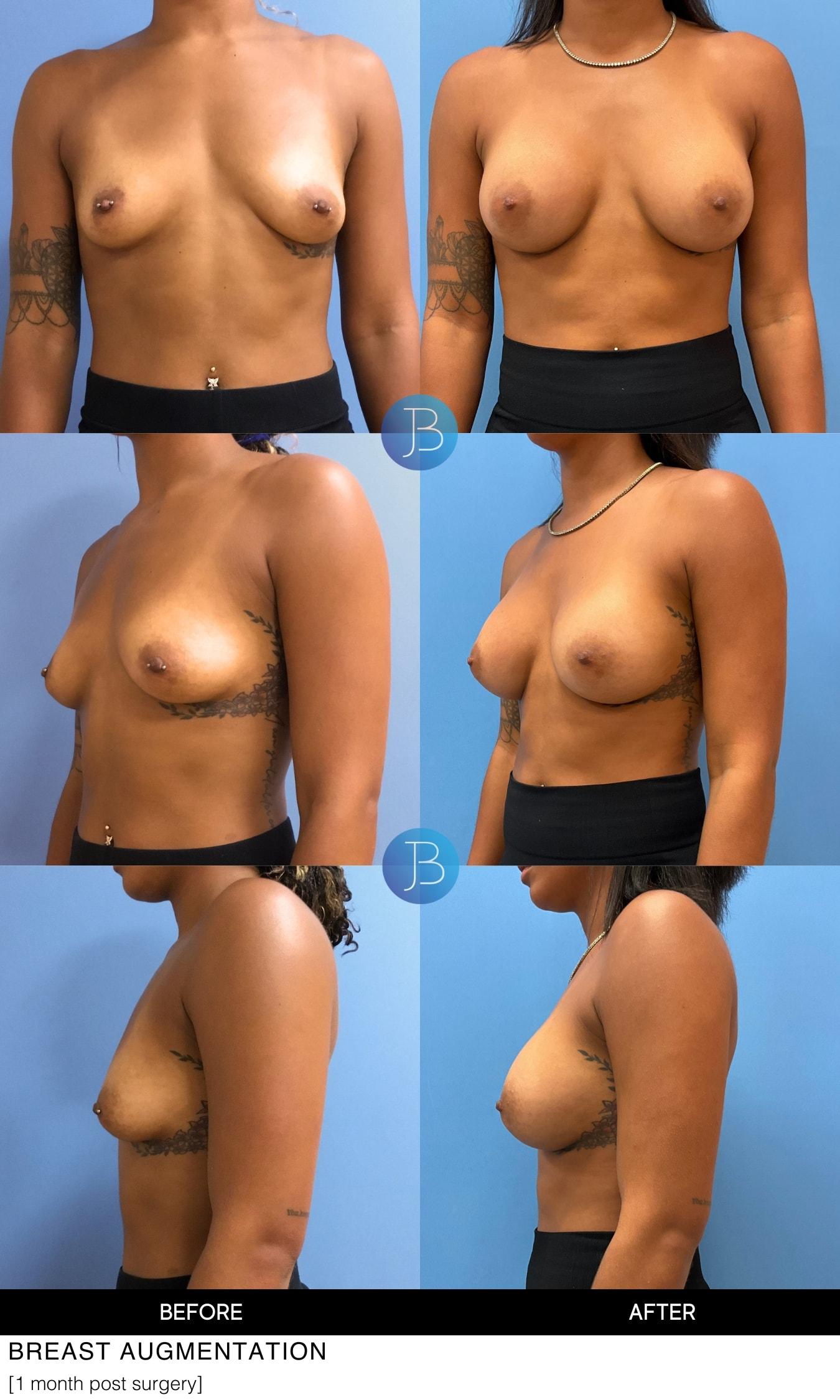Bloom Plastic Surgery breast augmentation result — Chicago, IL