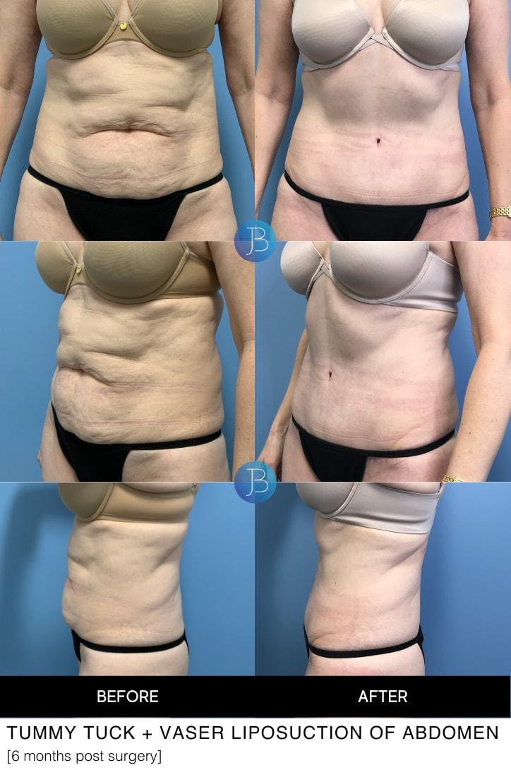 Bloom Plastic Surgery tummy tuck result — Chicago, IL