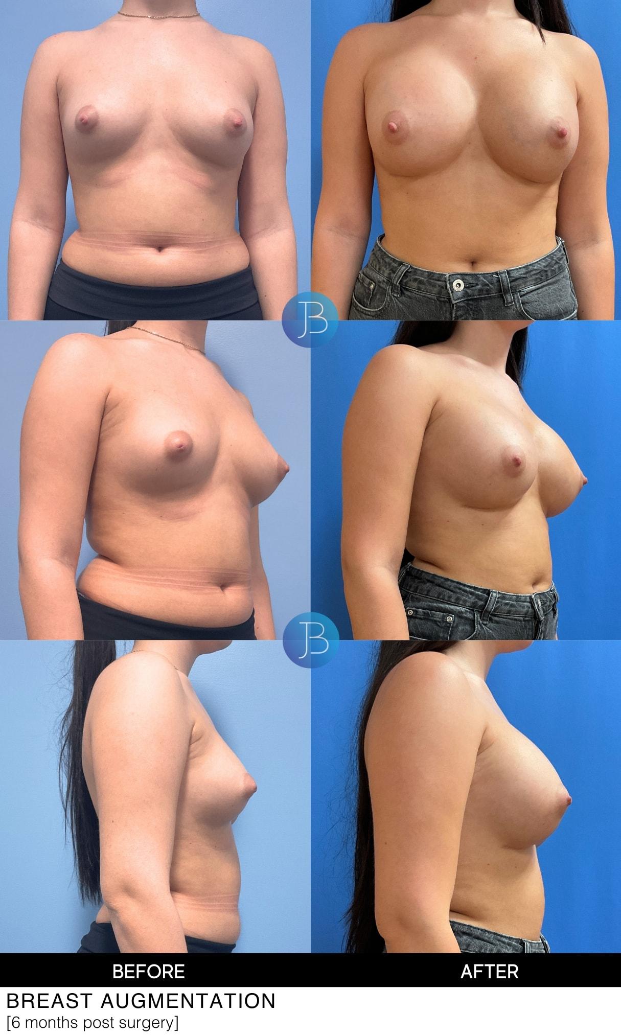 Bloom Plastic Surgery breast augmentation result — Chicago, IL
