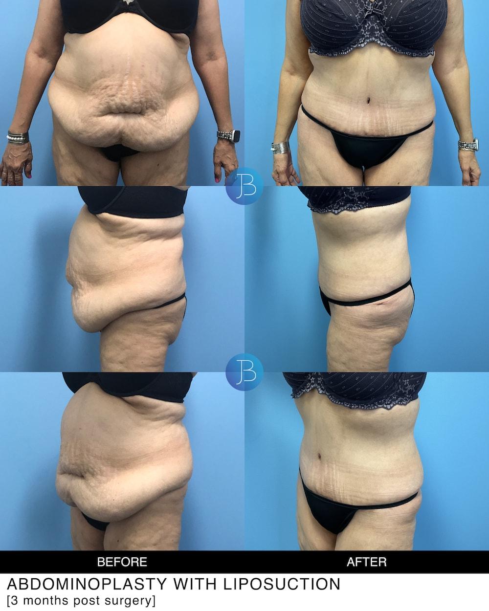 Bloom Plastic Surgery tummy tuck result — Chicago, IL