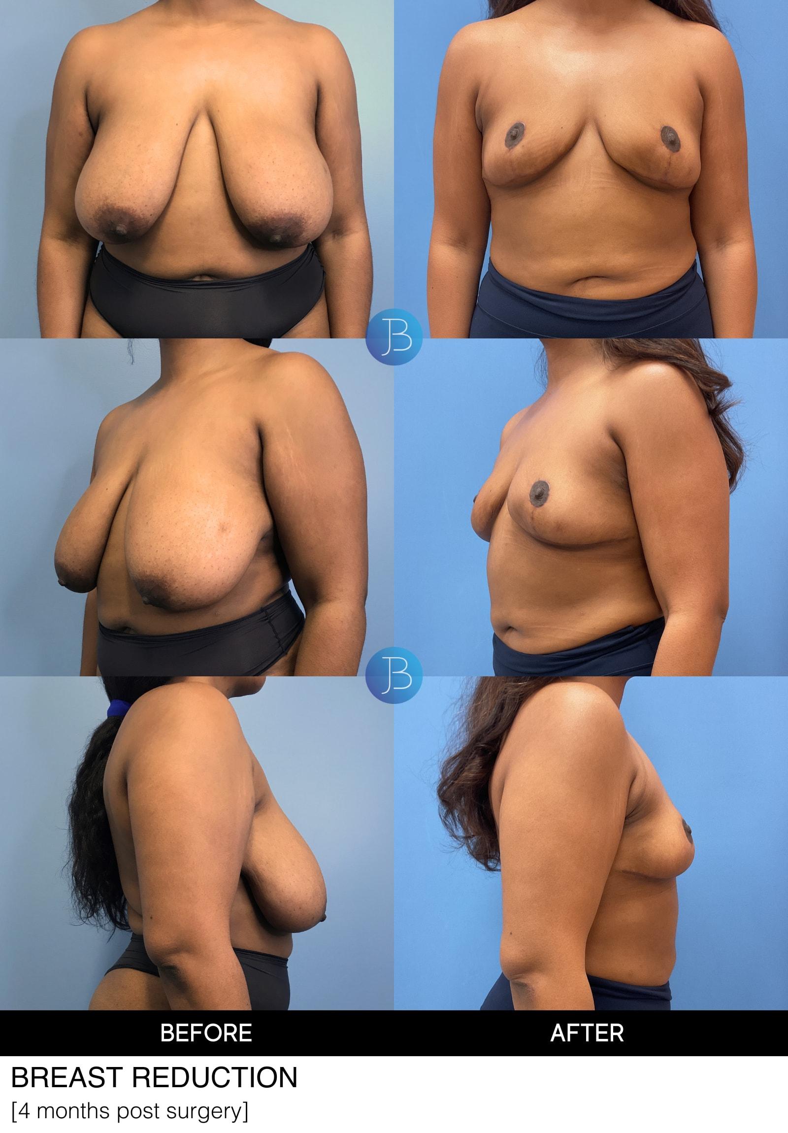 Bloom Plastic Surgery breast reduction result — Chicago, IL
