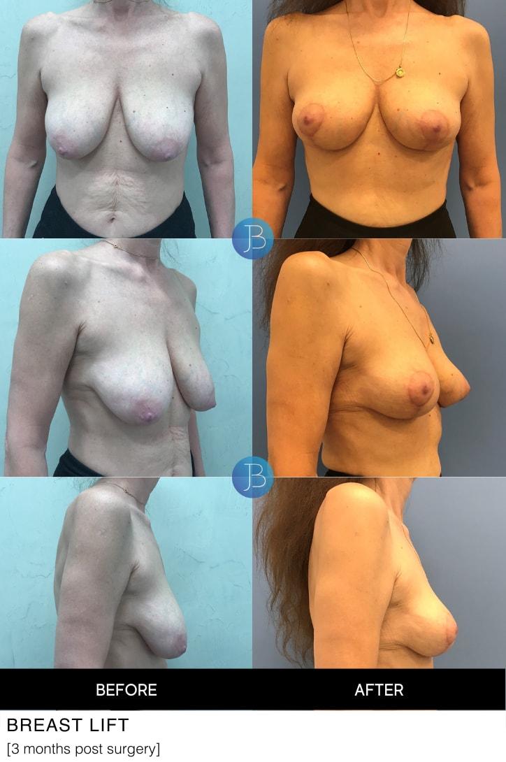 Bloom Plastic Surgery breast lift result — Chicago, IL
