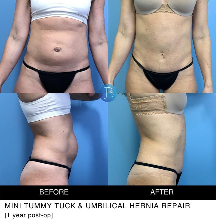 Bloom Plastic Surgery tummy tuck result — Chicago, IL