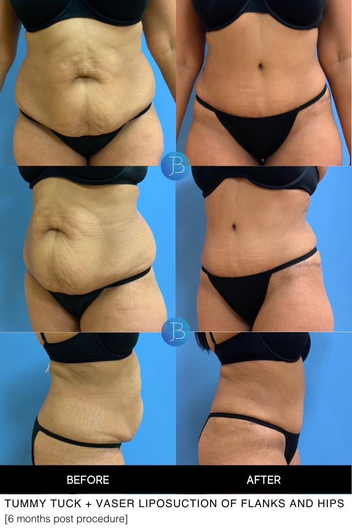 Bloom Plastic Surgery tummy tuck result — Chicago, IL