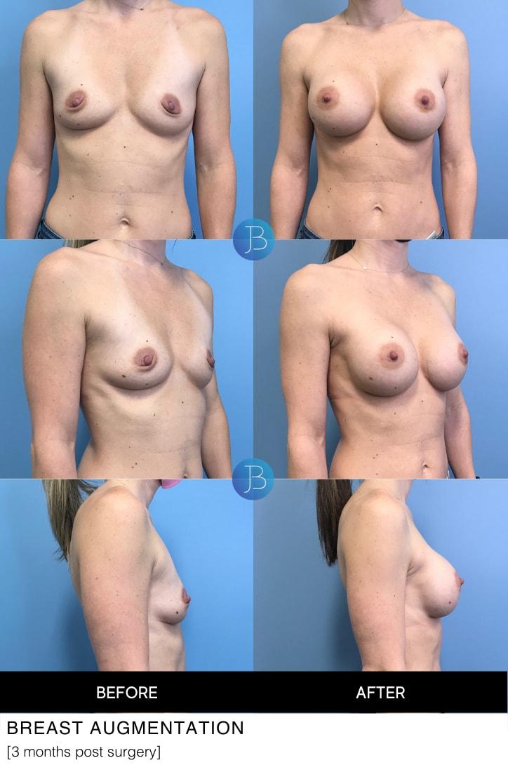 Bloom Plastic Surgery breast augmentation result — Chicago, IL