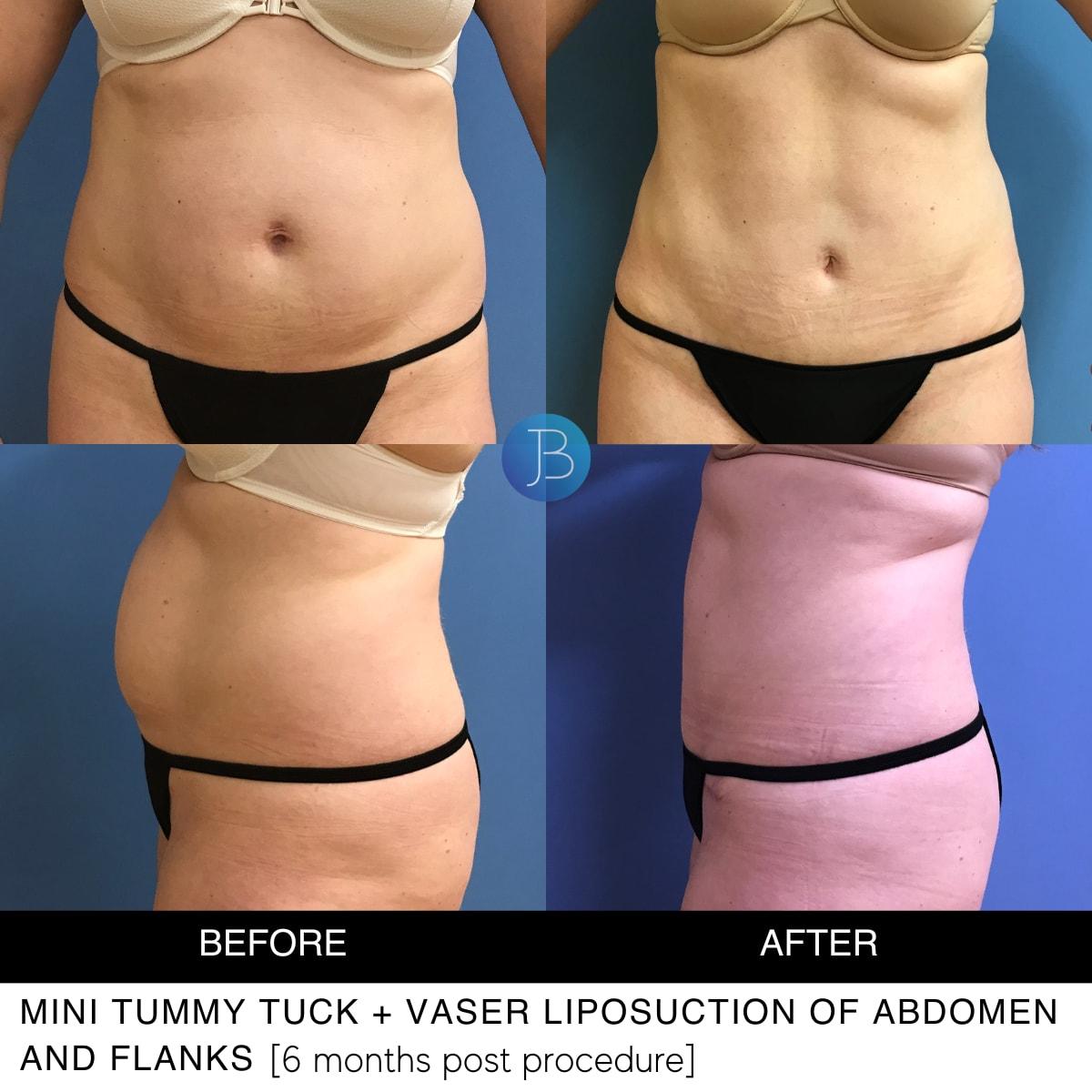 Bloom Plastic Surgery tummy tuck result — Chicago, IL