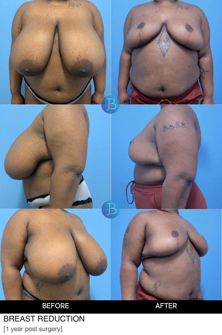 Bloom Plastic Surgery breast reduction result — Chicago, IL