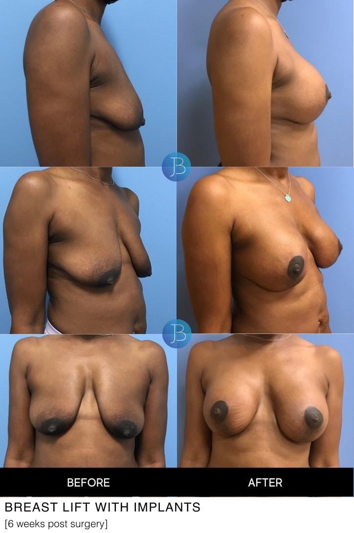 Bloom Plastic Surgery breast lift result — Chicago, IL
