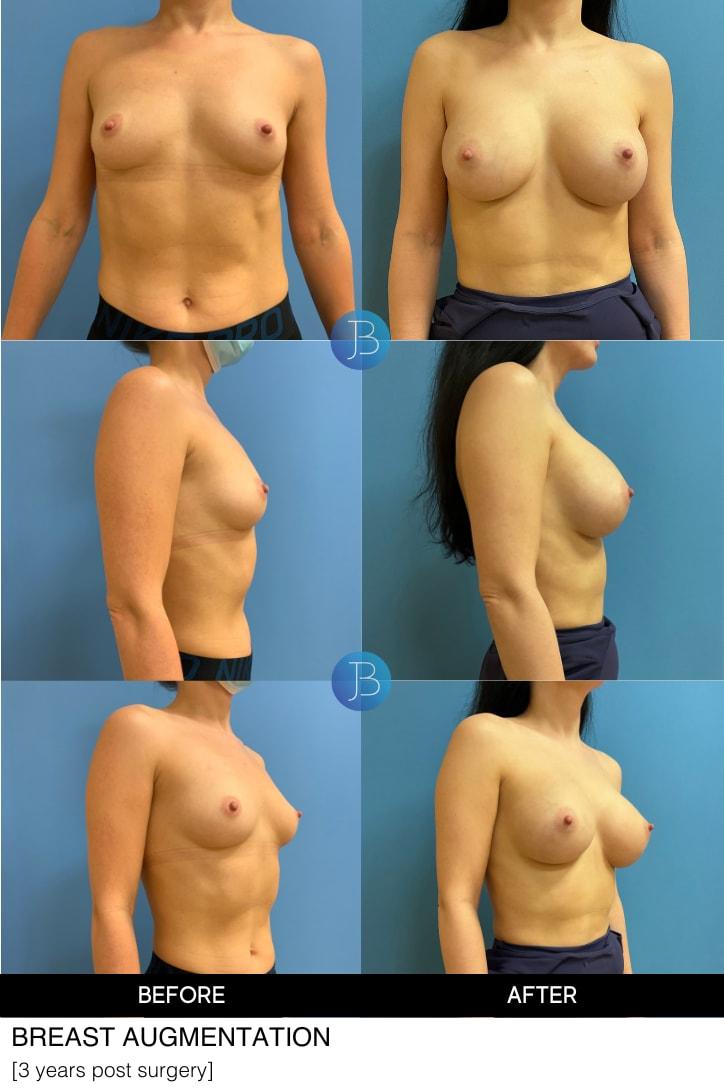 Bloom Plastic Surgery breast augmentation result — Chicago, IL