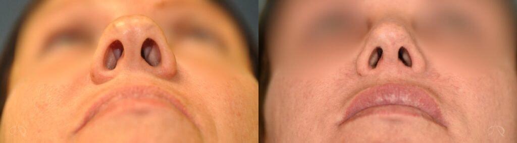 Aesthetix Plastic Surgery rhinoplasty result — Huntington Beach, CA