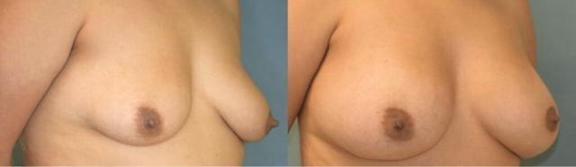 Breast Augmentation result at Aesthetix Plastic Surgery in Huntington Beach, CA