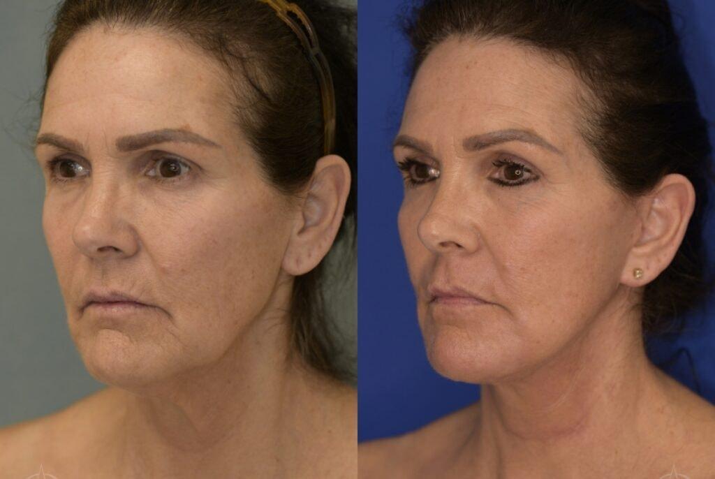 Aesthetix Plastic Surgery facelift result — Huntington Beach, CA