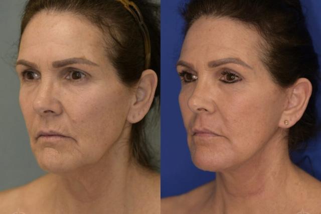 Deep Plane Facelift result at Aesthetix Plastic Surgery in Huntington Beach, CA