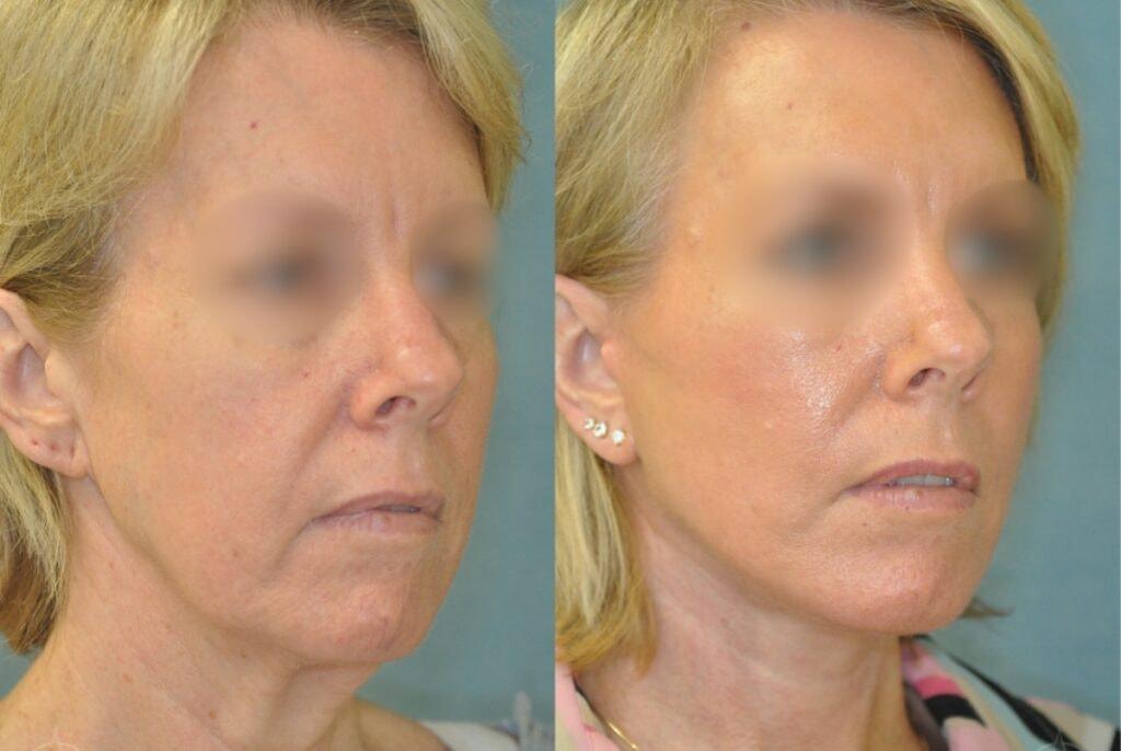 Aesthetix Plastic Surgery facelift result — Huntington Beach, CA