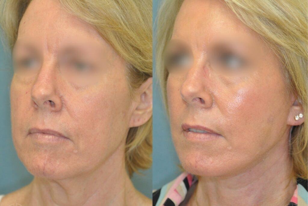 Aesthetix Plastic Surgery facelift result — Huntington Beach, CA