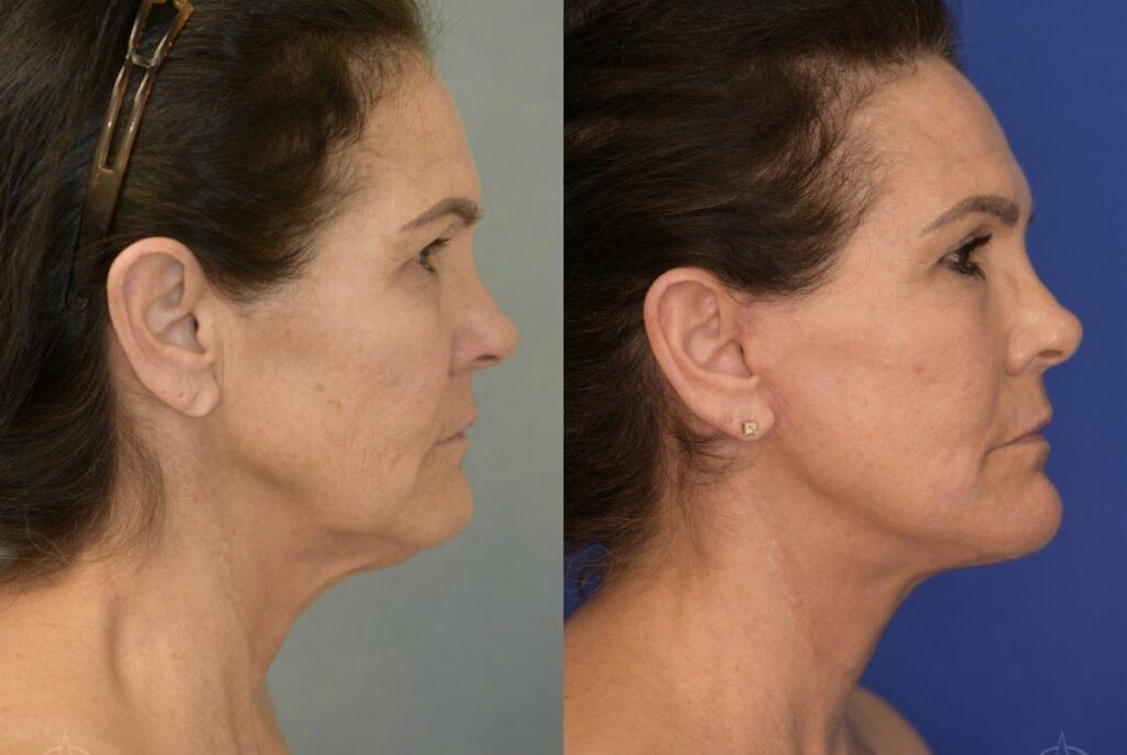 Aesthetix Plastic Surgery facelift result — Huntington Beach, CA
