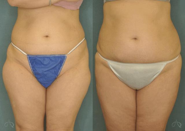 Liposuction result at Aesthetix Plastic Surgery in Huntington Beach, CA