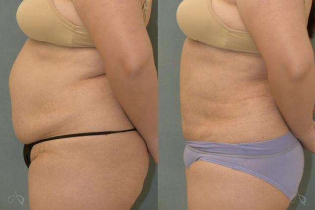 Liposuction result at Aesthetix Plastic Surgery in Huntington Beach, CA