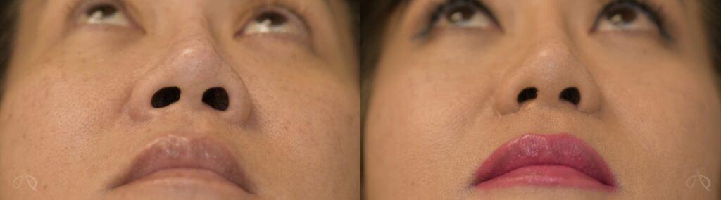 Aesthetix Plastic Surgery rhinoplasty result — Huntington Beach, CA