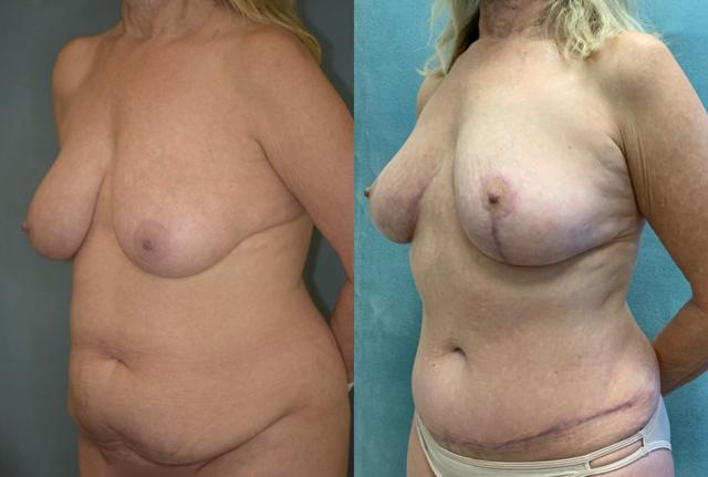 Mommy Makeover result at Aesthetix Plastic Surgery in Huntington Beach, CA