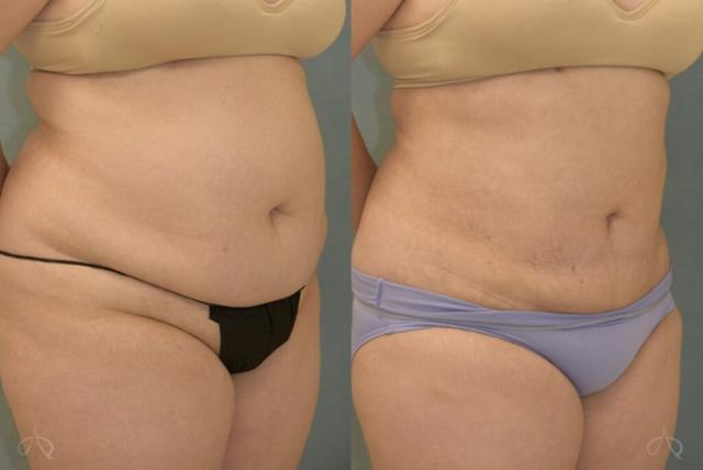 Liposuction result at Aesthetix Plastic Surgery in Huntington Beach, CA