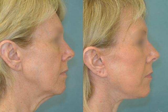 Deep Plane Facelift result at Aesthetix Plastic Surgery in Huntington Beach, CA