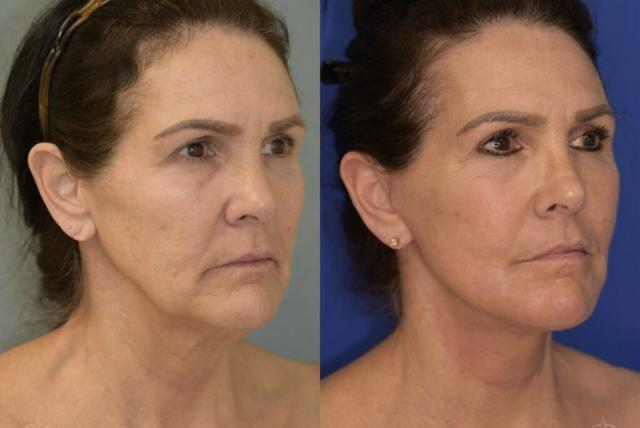 Deep Plane Facelift result at Aesthetix Plastic Surgery in Huntington Beach, CA
