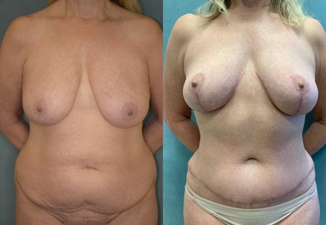 Mommy Makeover result at Aesthetix Plastic Surgery in Huntington Beach, CA