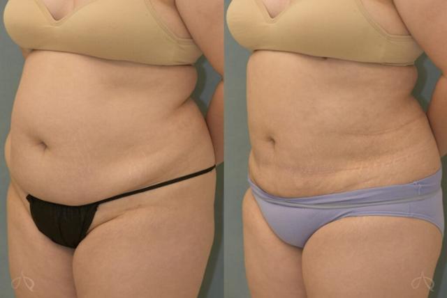 Liposuction result at Aesthetix Plastic Surgery in Huntington Beach, CA
